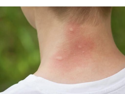 UJEO VAS JE KOMARAC, SAMO NAMAŽITE OVO: Svrab nestaje u sekundi, RIJEŠITE SE MUKE