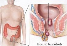 Tradicionalni Ruski lijek protiv hemoroida: Ovaj savjet pomogao je hiljadama ljudi