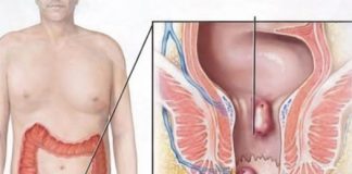 Tradicionalni Ruski lijek protiv hemoroida: Ovaj savjet pomogao je hiljadama ljudi