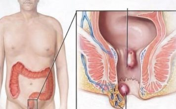 Tradicionalni Ruski lijek protiv hemoroida: Ovaj savjet pomogao je hiljadama ljudi
