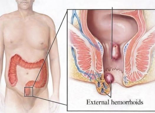 Tradicionalni Ruski lijek protiv hemoroida: Ovaj savjet pomogao je hiljadama ljudi
