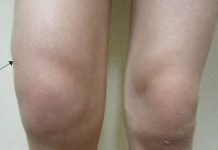 Voda u koljenu: Zašto dolazi do nakupljanja i kako taj problem riješiti?