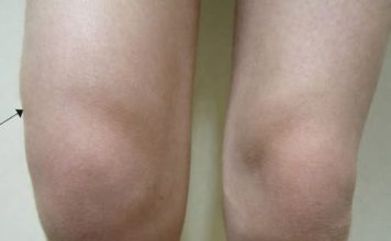 Voda u koljenu: Zašto dolazi do nakupljanja i kako taj problem riješiti?