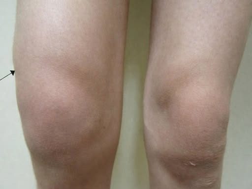 Voda u koljenu: Zašto dolazi do nakupljanja i kako taj problem riješiti?