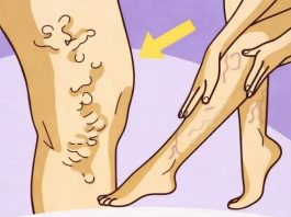 Savršen trik za liječenje proširenih vena, bolova u mišićima i celulita (RECEPT)