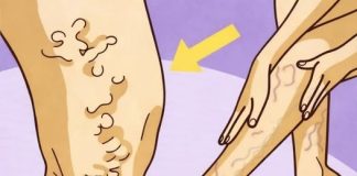 Savršen trik za liječenje proširenih vena, bolova u mišićima i celulita (RECEPT)