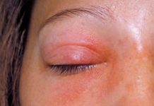 NAJMOĆNIJI LIJEK ZA SINUSE, OD SAMO 2 SASTOJKA: Prodisat ćete za tren oka (RECEPT)