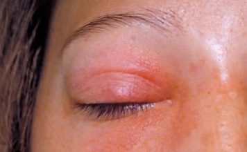 NAJMOĆNIJI LIJEK ZA SINUSE, OD SAMO 2 SASTOJKA: Prodisat ćete za tren oka (RECEPT)