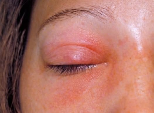 NAJMOĆNIJI LIJEK ZA SINUSE, OD SAMO 2 SASTOJKA: Prodisat ćete za tren oka (RECEPT)