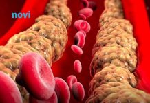 Ako imate povišen holesterol nikako nemojte ovo da jedete! Stvara ozbiljne probleme