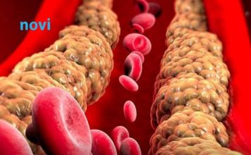 Ako imate povišen holesterol nikako nemojte ovo da jedete! Stvara ozbiljne probleme