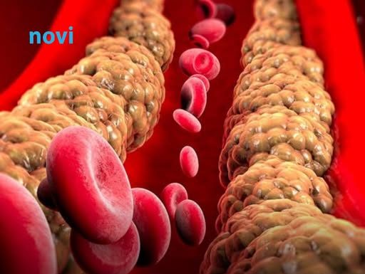 Ako imate povišen holesterol nikako nemojte ovo da jedete! Stvara ozbiljne probleme