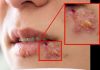 Herpes na usni: Evo kako da ga uklonite bukvalno za samo jedno veče jedan dan! Sve što vam treba za to je…