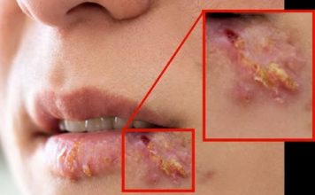 Herpes na usni: Evo kako da ga uklonite bukvalno za samo jedno veče jedan dan! Sve što vam treba za to je…