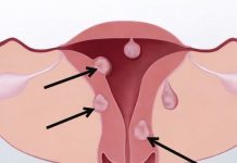 Žene obratite pažnju: Ovo su prvi simptomi mioma materice, obično ih je više, a ovi su najčešći