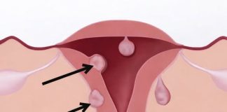 Žene obratite pažnju: Ovo su prvi simptomi mioma materice, obično ih je više, a ovi su najčešći