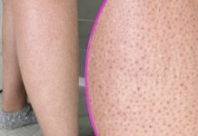 OVE TAČKICE NA NOGAMA VAM KVARE LJETO? Evo kako da ih se riješite, koža će vam biti glatka