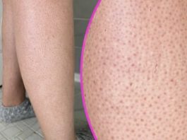 OVE TAČKICE NA NOGAMA VAM KVARE LJETO? Evo kako da ih se riješite, koža će vam biti glatka