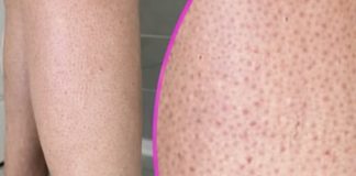 OVE TAČKICE NA NOGAMA VAM KVARE LJETO? Evo kako da ih se riješite, koža će vam biti glatka