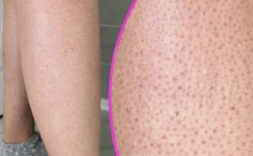 OVE TAČKICE NA NOGAMA VAM KVARE LJETO? Evo kako da ih se riješite, koža će vam biti glatka