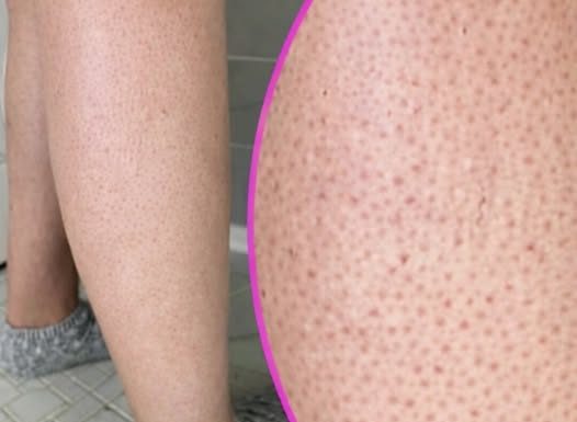 OVE TAČKICE NA NOGAMA VAM KVARE LJETO? Evo kako da ih se riješite, koža će vam biti glatka