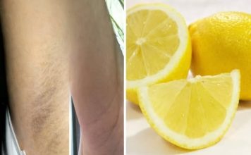 Tamne mrlje ispod pazuha – 5 prirodnih rješenja