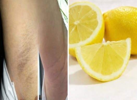 Tamne mrlje ispod pazuha – 5 prirodnih rješenja