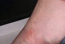 OVE SIMPTOME NIKAKO NE IGNORIŠITE! To je znak da se u tijelu formira TROMB opasan po ŽIVOT