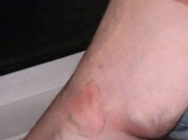 OVE SIMPTOME NIKAKO NE IGNORIŠITE! To je znak da se u tijelu formira TROMB opasan po ŽIVOT