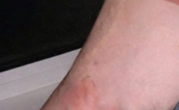 OVE SIMPTOME NIKAKO NE IGNORIŠITE! To je znak da se u tijelu formira TROMB opasan po ŽIVOT