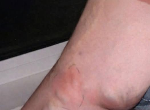 OVE SIMPTOME NIKAKO NE IGNORIŠITE! To je znak da se u tijelu formira TROMB opasan po ŽIVOT