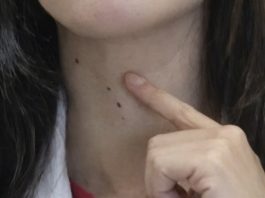 ŠTITNA ŽLIJEZDA SE PREPORODI ZA NEKOLIKO NEDJELJA: Dovedite hormone u red prirodnim sredstvima