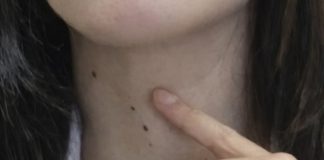 ŠTITNA ŽLIJEZDA SE PREPORODI ZA NEKOLIKO NEDJELJA: Dovedite hormone u red prirodnim sredstvima