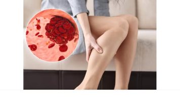 Kako da prepoznate tromb u telu? Ne ignorišite ovih 8 znakova upozorenja