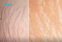 Jedna biljka kao skalpelom briše sve ožiljke, opekotine i strije, a koža se podmlađuje