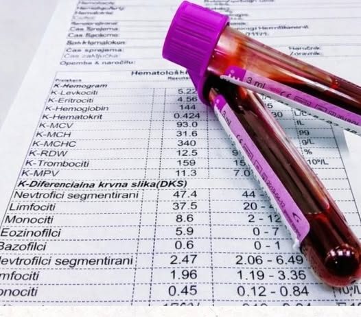 TUMAČENJE KRVNE SLIKE: Šta znače sve one skraćenice i na šta upućuju njihove vrednosti!