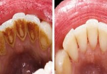 EVO KAKO DA SAMI UKLONITE SAV KAMENAC SA ZUBA: Napravite ovu smjesu i bićete oduševljeni rezultatom! (RECEPT)