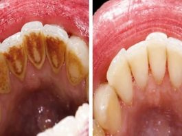 EVO KAKO DA SAMI UKLONITE SAV KAMENAC SA ZUBA: Napravite ovu smjesu i bićete oduševljeni rezultatom! (RECEPT)