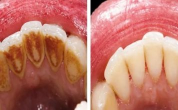 EVO KAKO DA SAMI UKLONITE SAV KAMENAC SA ZUBA: Napravite ovu smjesu i bićete oduševljeni rezultatom! (RECEPT)