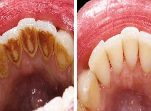 EVO KAKO DA SAMI UKLONITE SAV KAMENAC SA ZUBA: Napravite ovu smjesu i bićete oduševljeni rezultatom! (RECEPT)