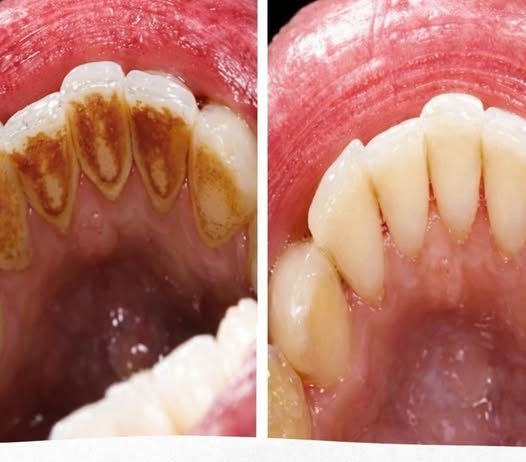 EVO KAKO DA SAMI UKLONITE SAV KAMENAC SA ZUBA: Napravite ovu smjesu i bićete oduševljeni rezultatom! (RECEPT)