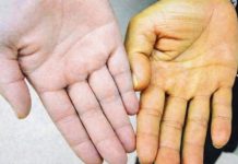 Rak jetre ima 8 simptoma: Obratite pažnju