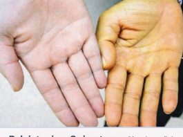 Rak jetre ima 8 simptoma: Obratite pažnju