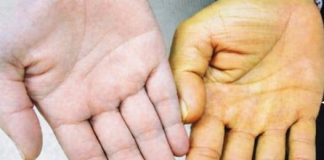 Rak jetre ima 8 simptoma: Obratite pažnju