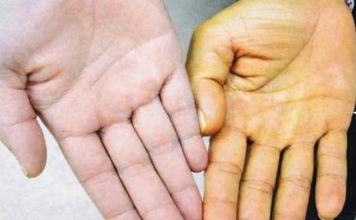 Rak jetre ima 8 simptoma: Obratite pažnju