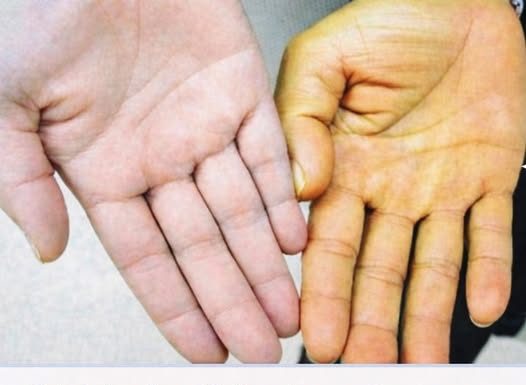 Rak jetre ima 8 simptoma: Obratite pažnju