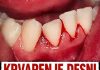 Krvarenje desni nije slučajnost: Evo o kojoj bolesti se radi!