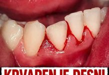Krvarenje desni nije slučajnost: Evo o kojoj bolesti se radi!
