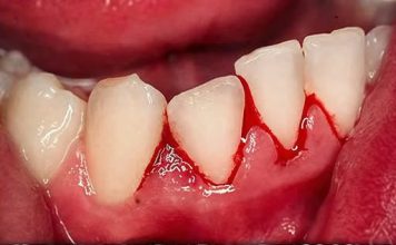 Krvarenje desni nije slučajnost: Evo o kojoj bolesti se radi!