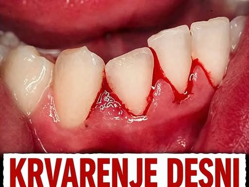 Krvarenje desni nije slučajnost: Evo o kojoj bolesti se radi!